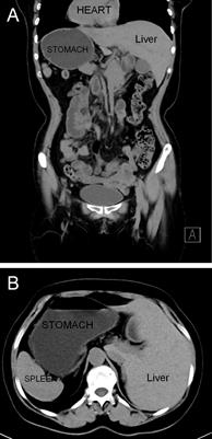 Case Report: Transvaginal specimen extraction following totally laparoscopic D2 distal gastrectomy for gastric cancer in a patient with situs inversus totalis: with video